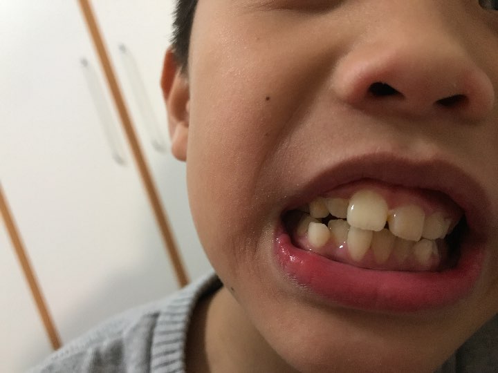 请问,我家八岁的孩子换牙期有点龅牙
