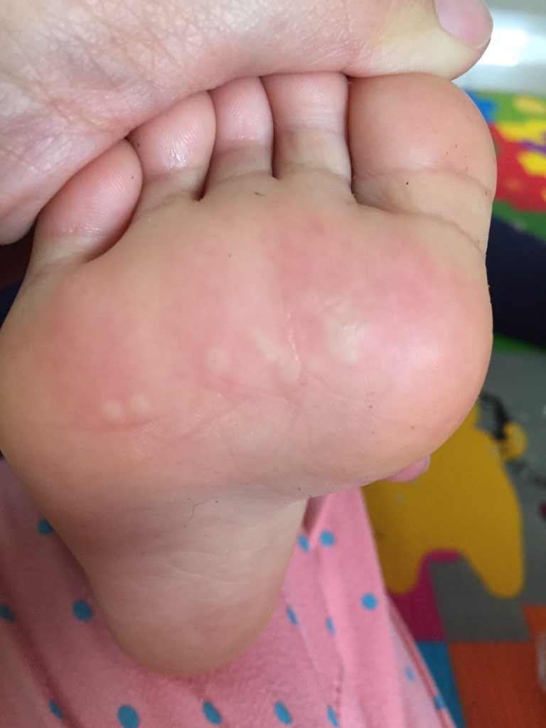 宝宝脚底痒三四天了刚开始以为是被蚊子咬了但是现在图片看来