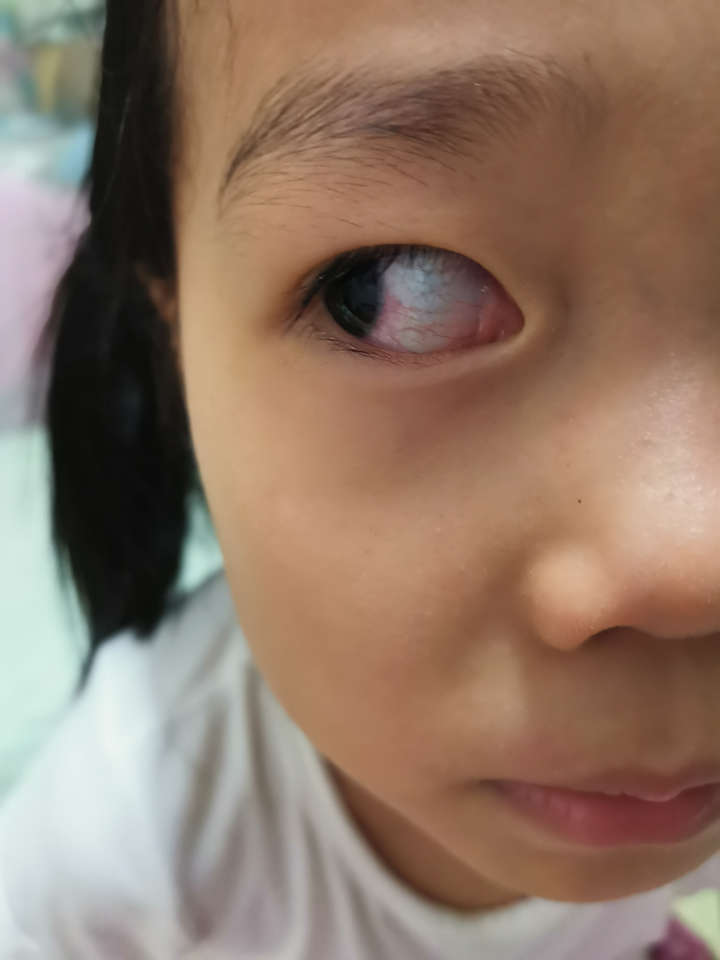 小孩对眼的图片症状图片
