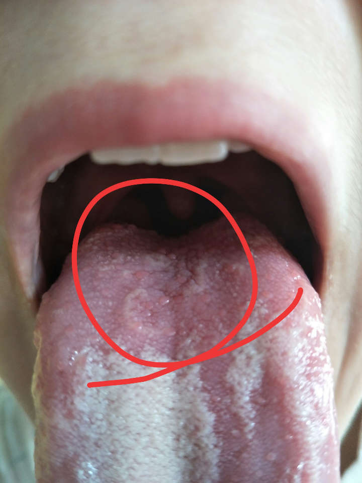 舌头根部起泡图片图片