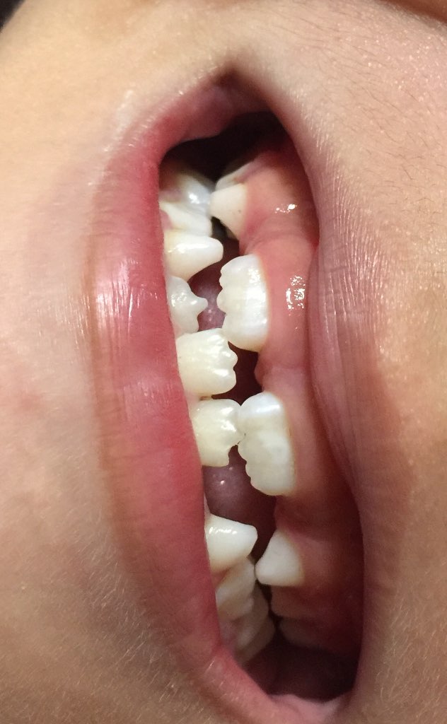 牙医妈妈请问一下六岁孩子正在萌出的两颗上门牙各有一块不规则形